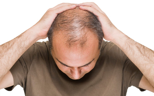 Baldness in Men - Androgenetic Alopecia