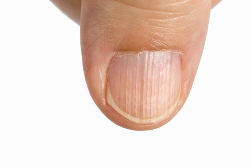 What are Nail Ridges?