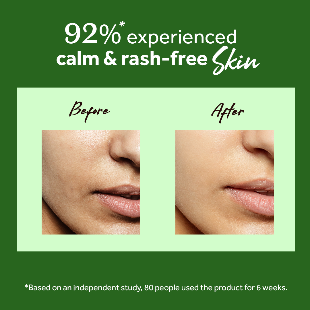 Atulya Tea Tree Essential Oil | Purifies Skin & Scalp | For Blemishes & Dandruff | 15 ml