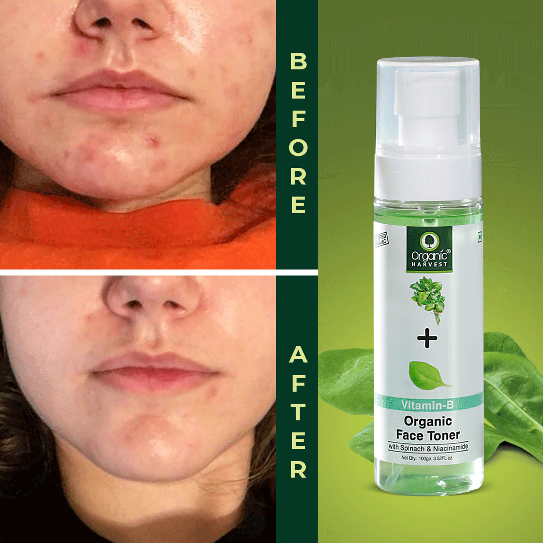 Acne Control Mattifying Face Toner with Green Tea & Moringa Extracts - 100ml